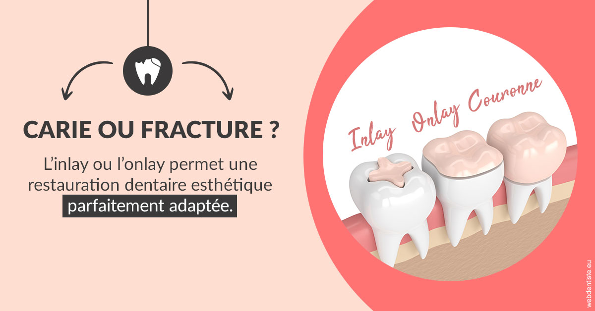 https://dr-bealem-borris.chirurgiens-dentistes.fr/T2 2023 - Carie ou fracture 2