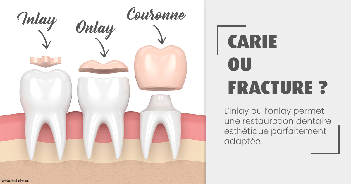 https://dr-bealem-borris.chirurgiens-dentistes.fr/T2 2023 - Carie ou fracture 1