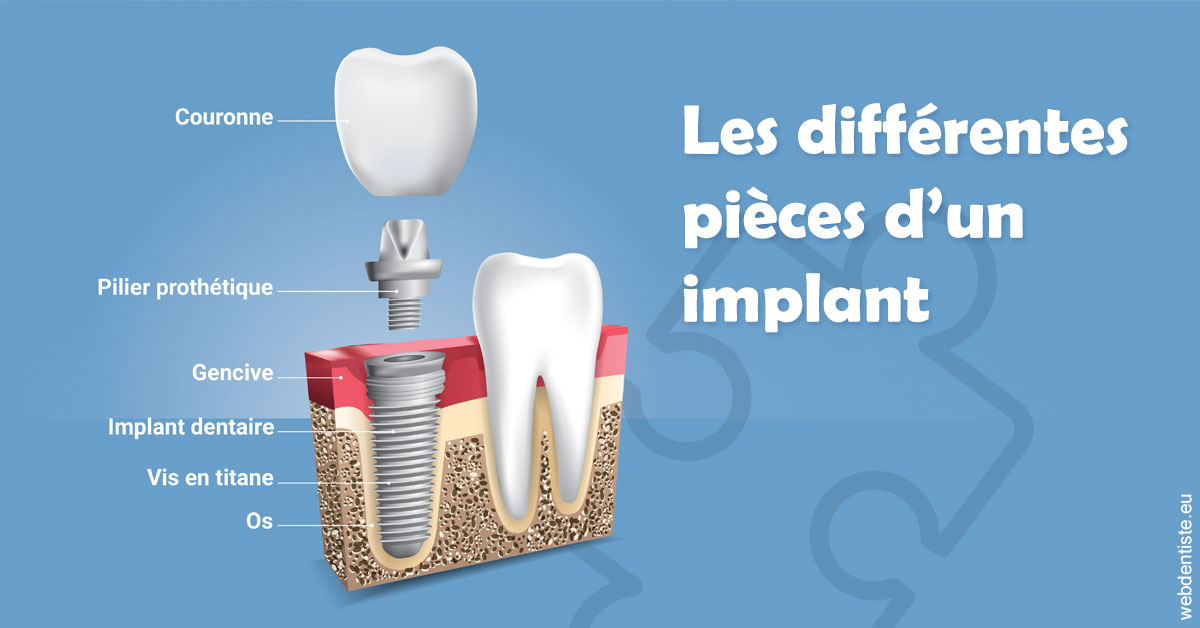 https://dr-bealem-borris.chirurgiens-dentistes.fr/Les différentes pièces d’un implant 1